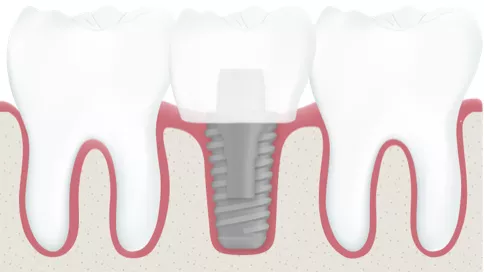 Zahnlücke mit einem Zahnimplantat versorgen