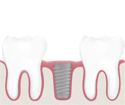 Zahnarzt - Implantatschraube